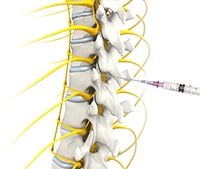 Caudal Epidural Steroid Injection