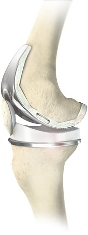 Total Knee Replacement