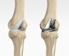 Total Knee Replacement