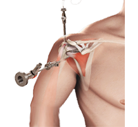 Arthroscopic Rotator Cuff Repair