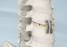 Cervical Spine Fusion