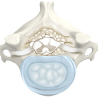 Cervical Stenosis