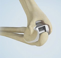 Total Elbow Replacement