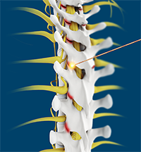 Facet Joint Rhizolysis