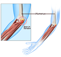 Golfer's Elbow Surgery  