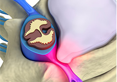 Herniated Disc (Lumbar)