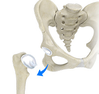 Hip Dislocation