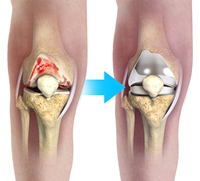 Minimally Invasive Total Knee Arthroplasty