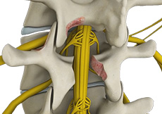 Lumbar Decompression