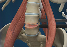 Minimally Invasive Lumbar Fusion