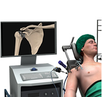 Minimally Invasive Shoulder Joint Replacement