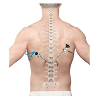 Minimally Invasive Spine Surgery