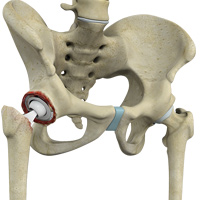 Revision Hip Replacement