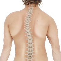 Scoliosis