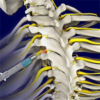 Nerve Root Injections