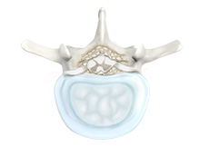 Lumbar Stenosis