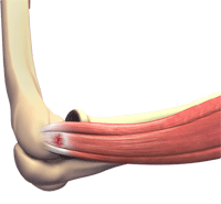 Tennis Elbow Surgery