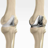 Total Knee Replacement