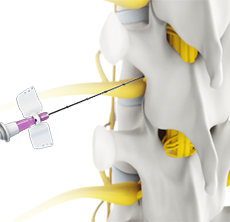 Transforaminal Epidural Steroid Injection image