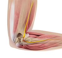 Ulnar Nerve Transposition 